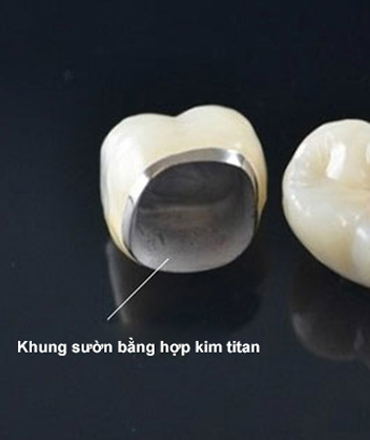 Răng sứ Titan