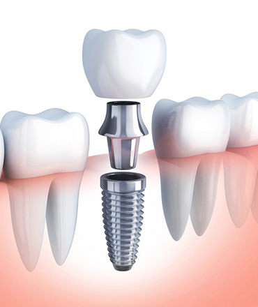 Implant