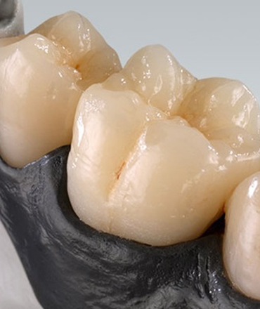 Răng Sứ Ceramill Zolid